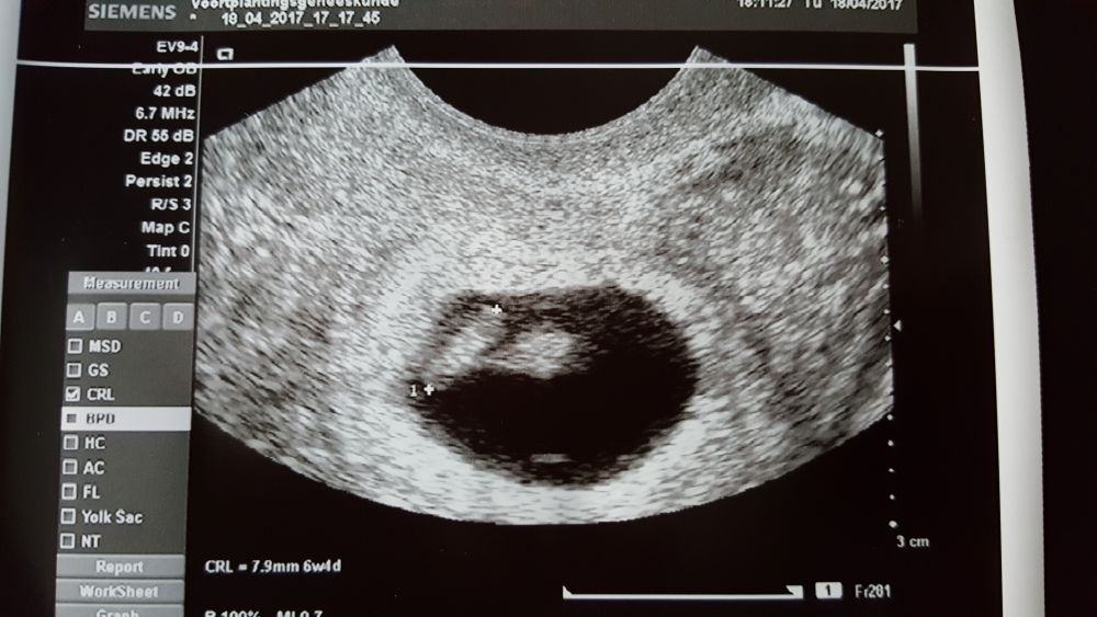 echo prille zwangerschap _ eerste trimester -